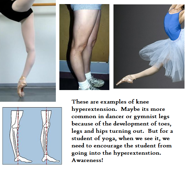 What is a naturally hyperextended knee called?